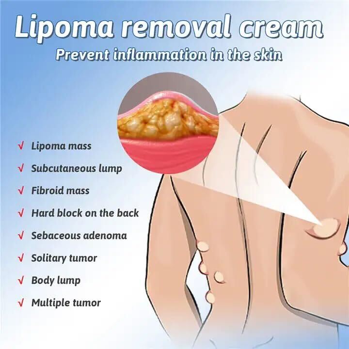 Herbal Lipoma Cream Peeling Fat Mass Remove Miracle Ointment